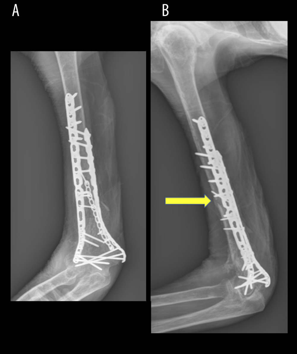 Anterior-posterior (A) and lateral (B) radiographs taken at 3-month follow-up office visit. Arrow highlights bridging bone across the principal fracture line.
