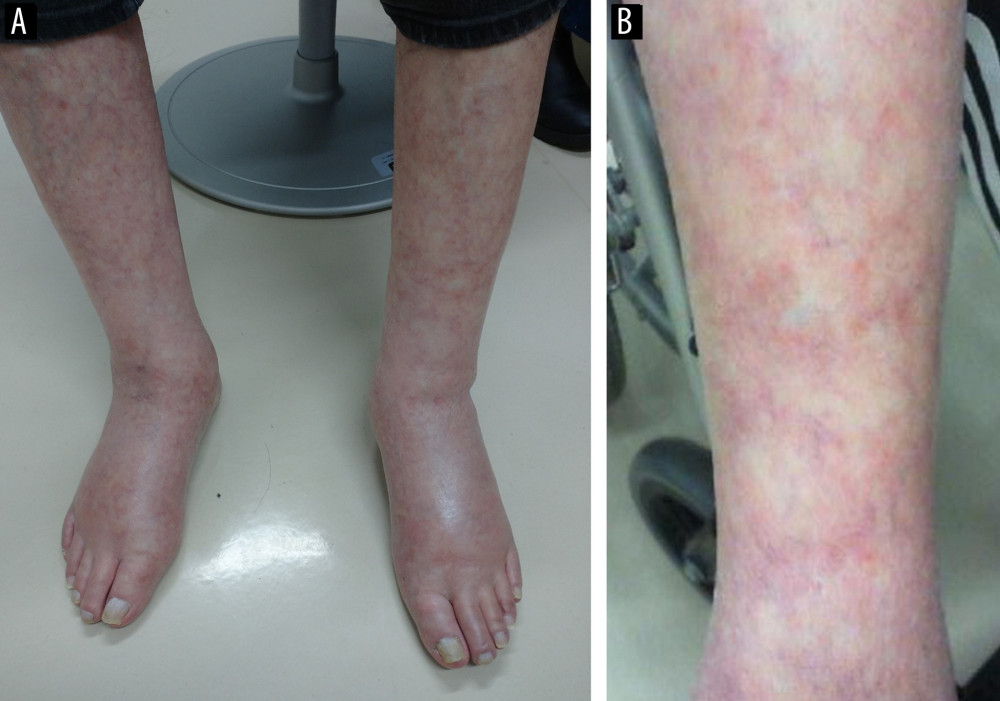 (A) Bilateral pitting edema of the lower legs with concurrent livedo reticularis in the same area; (B) characteristics of the lesions.