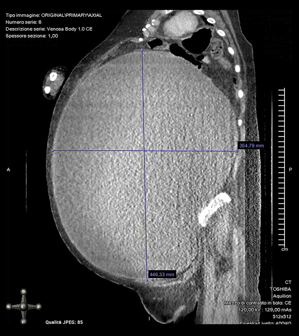 Computed tomography scan view of giant ovarian tumor.