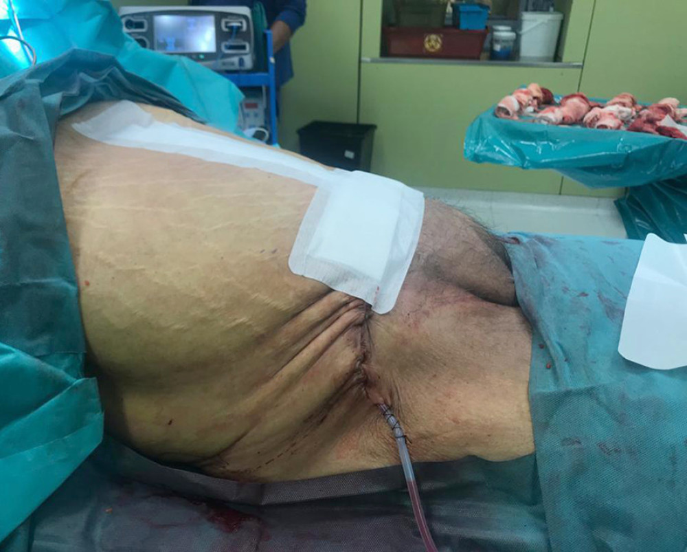 View of the abdomen after surgery.