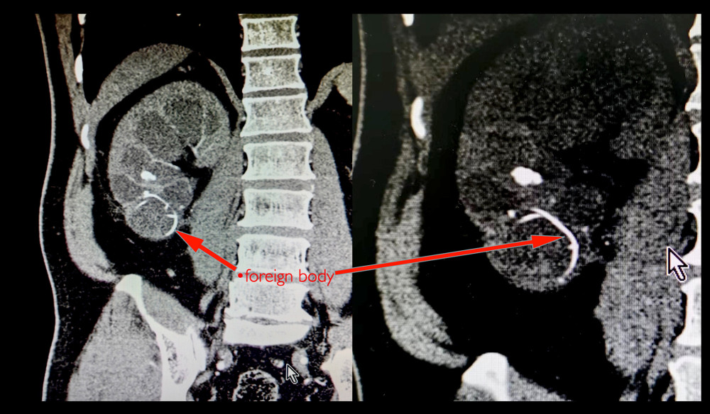 Preoperative computed tomography urogram shows a hyperdense foreign object in the lower pole of the right kidney.