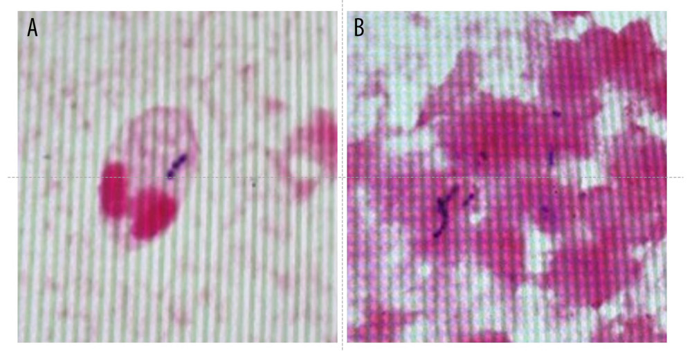 The pictures of gram-positive bacteria from (A) the ankle fluid and (B) blood culture.