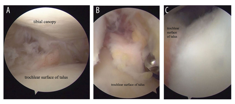 Arthroscopic findings of the left ankle. (A) Tibial canopy and trochlear surface of talus remained intact, and synovitis covered the posterior side. (B) Medial part of the talar pulley was covered by an inflammatory synovium. (C) Lateral side of the articular of ankle was covered by synovitis.