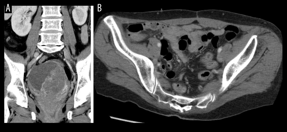 Contrast-enhanced computed tomography (CT) images of the pelvis. (A) Coronal and (B) axial CT showed no evidence of recurrent ovarian cancer and infected lesions such as abscesses.