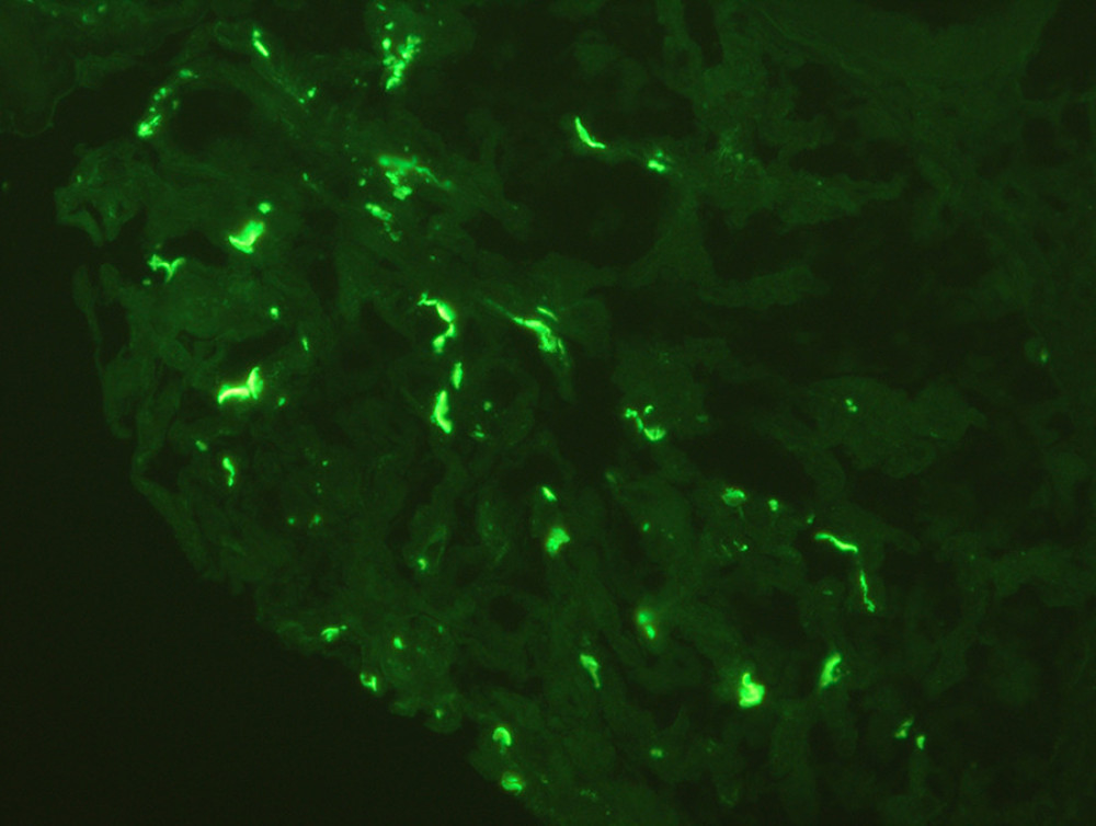 Direct immunofluorescence. 40×. C3 main deposits in mesangial area.