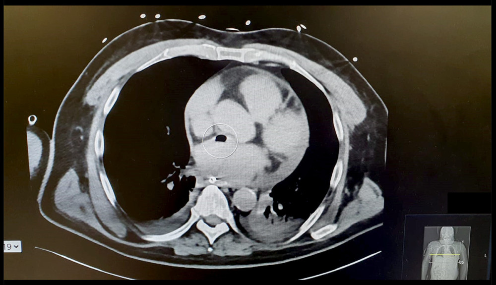 Air in left atrium. Coronal section of a chest computed tomography scan of patient no. 1 showing a large air bubble (circle) in left atrium caused by the atrio-esophageal fistula.