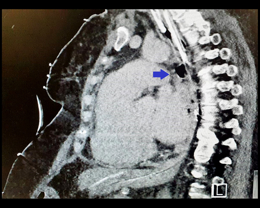 Air and tract from the atrium to the esophagus. Sagittal section of a chest computed tomography scan of patient no. 2 showing air and tract (blue arrow) from the left atrium to the esophagus.