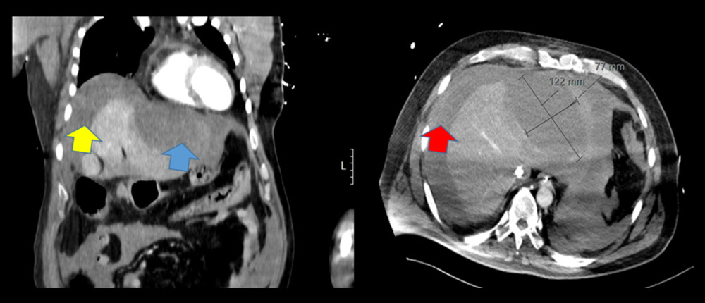 Abdominal CT scan. On the left, coronal view of abdominal CT showing hemoperitoneum surrounding the hepatic capsule (yellow arrow) as well as hepatic laceration (blue arrow). On the right, cross section of abdomen showing measurement of intrahepatic hematoma as well as surrounding subcapsular hematoma (red arrow).