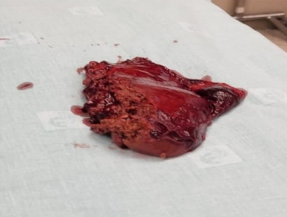 Hepatectomy. Specimen of lacerated liver lobe in operating room.