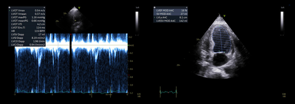 Echocardiography Day 5. On the left, pulse wave (PW) images showing a reduction in VTI to 4.2cm correlating approximately to 10–15% EF. On the right, cross section echocardiographic images using the “Simpson” estimation of 16% EF.