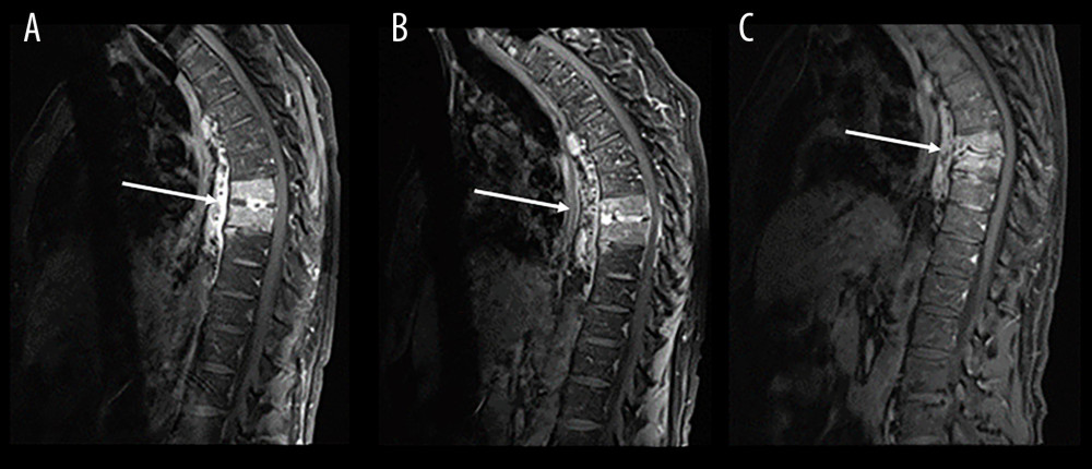 Progression of T7-T8 osteomyelitis/discitis on T2-series magnetic resonance imaging (MRI), sagittal sections. (A) Initial MRI showing T7-T8 osteomyelitis and discitis with paraspinal soft tissue involvement (arrow). (B) MRI of T7-T8 after readmission with worsening back pain showing progressive discitis/osteomyelitis, phlegmonous changes, and a small, left-sided paraspinal abscess (arrow). (C) MRI after completion of the second round of intravenous antibiotics showing improvement of the T7-T8 discitis/osteomyelitis and decreased soft tissue inflammation (arrow), which was coupled with clinical improvement.