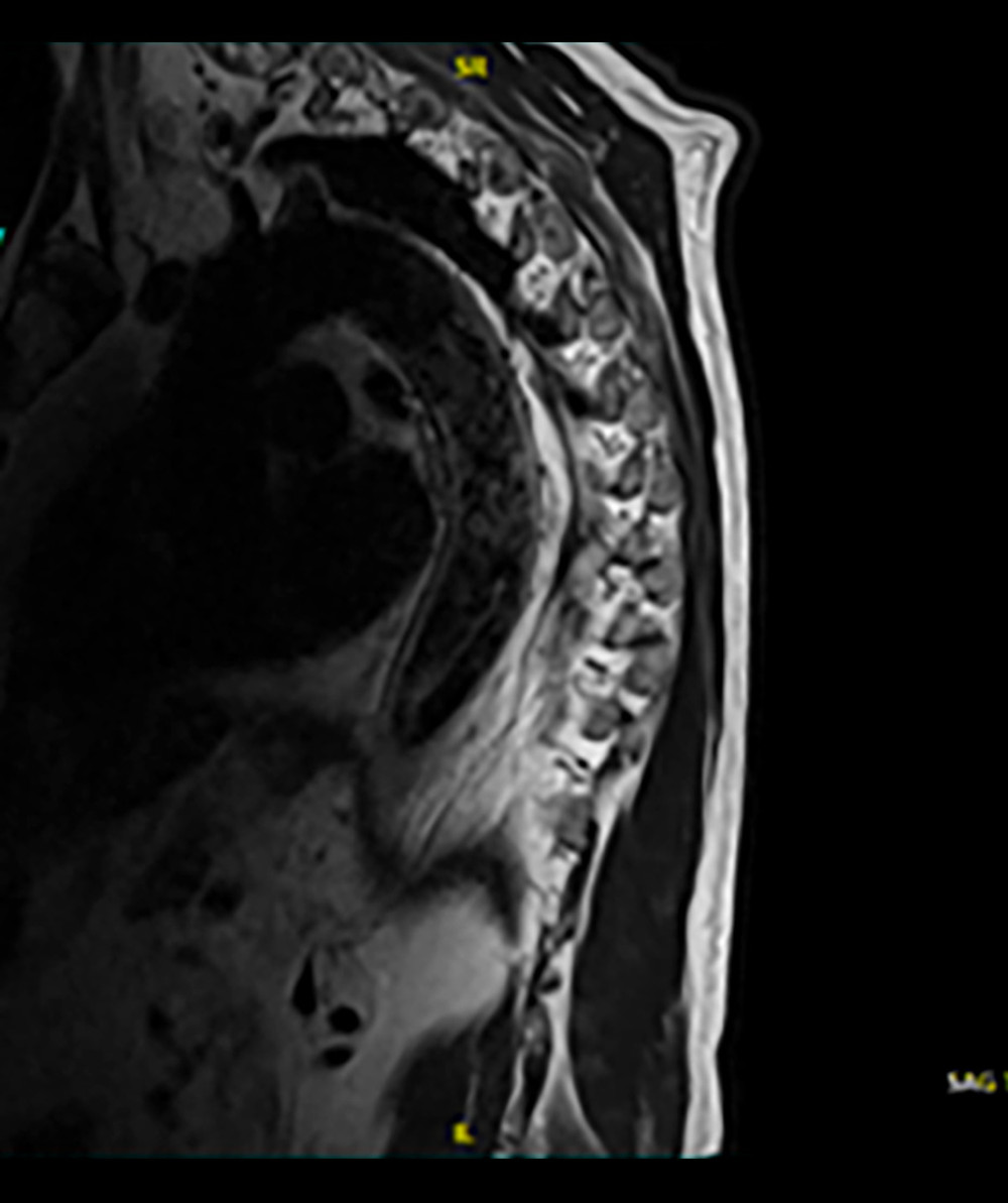 T2-series magnetic resonance imaging, sagittal sections, showing interval resolution of T7-T8 osteomyelitis.