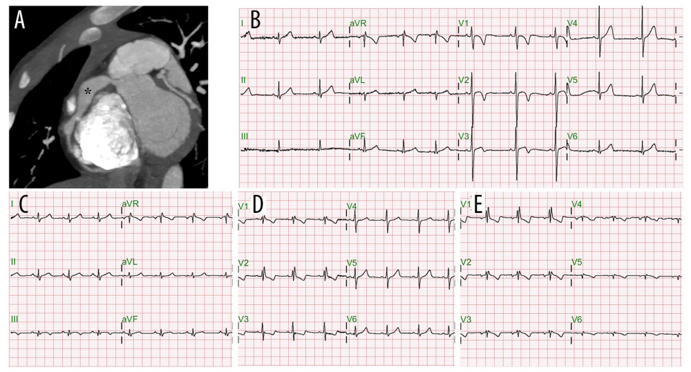 (A) In the convalescent stage, computed tomography revealed giant right coronary artery aneurysm (asterisk) with an internal diameter of 8.8 mm. (B) Baseline electrocardiography 2 years before this episode. (C) Electrocardiography, standard limb leads, T-wave inversion in lead III, and ST-T changes in lead III and aVf. (D) Left-side precordial electrocardiography, newly appeared incomplete right bundle branch block, and ST depression in lead V3. (E) Complete right-side precordial electrocardiography, newly appeared incomplete right bundle branch block, and ST-T change over right leads. There was no ST-elevation in lead V4R-V6R.