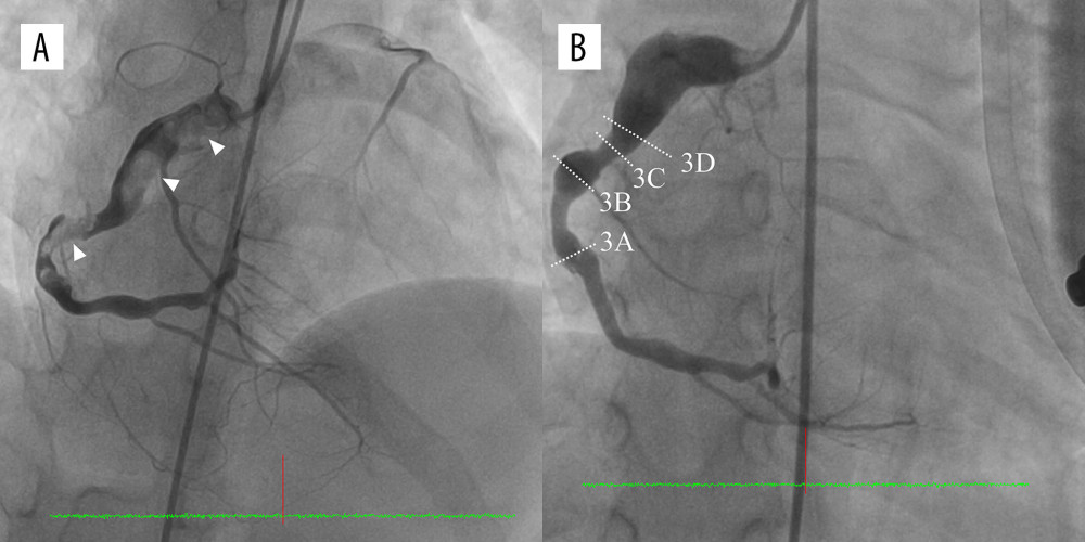 (A) Right coronary angiography revealed thrombotic occlusion of aneurysms (arrowhead). (B) Right coronary angiography after aspiration thrombectomy. Dash lines denote the different levels we acquired in OCT images. “3A”: Figure 3A, “3B”: Figure 3B, “3C”: Figure 3C, “3D”: Figure 3D.
