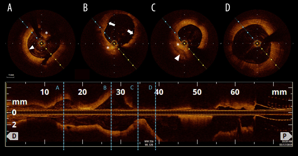 Optical coherence tomography images. (A) White thrombus (asterisk) with concentric intimal thickening (arrowhead). (B) Aneurysm with uneven edge, irregular thickening and absent border of the intima and media layer. (C) Calcification (arrowhead) with eccentric intimal thickening (asterisk). (D) Irregular intimal thickening with uneven edge (arrow) and destruction of medial layer (asterisk).