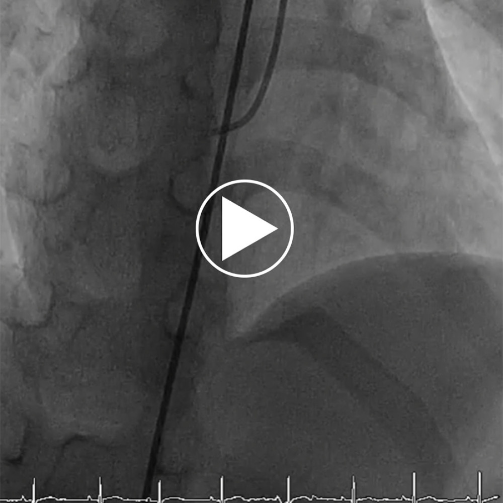 Right coronary angiography found acute thrombotic occlusion of the right coronary artery giant aneurysm. The contrast passes through the obstructed aneurysm and opacifies the coronary artery distal to the obstruction, which indicated thrombolysis in myocardial infarction grade 2 flow.