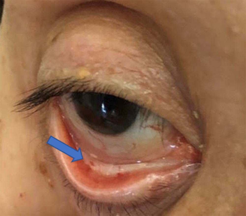 Hemorrhage in the conjunctiva of the right eye (arrow).