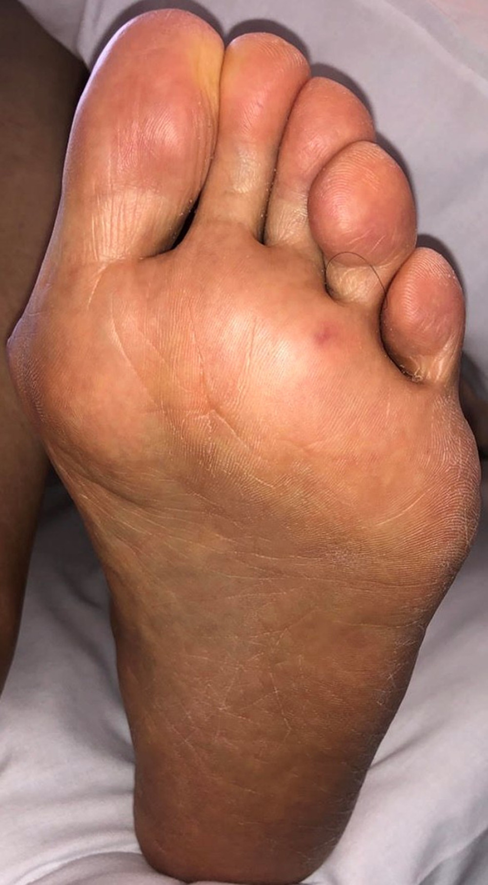 Painless nodules (Janeway lesions) on the sole of the left foot.