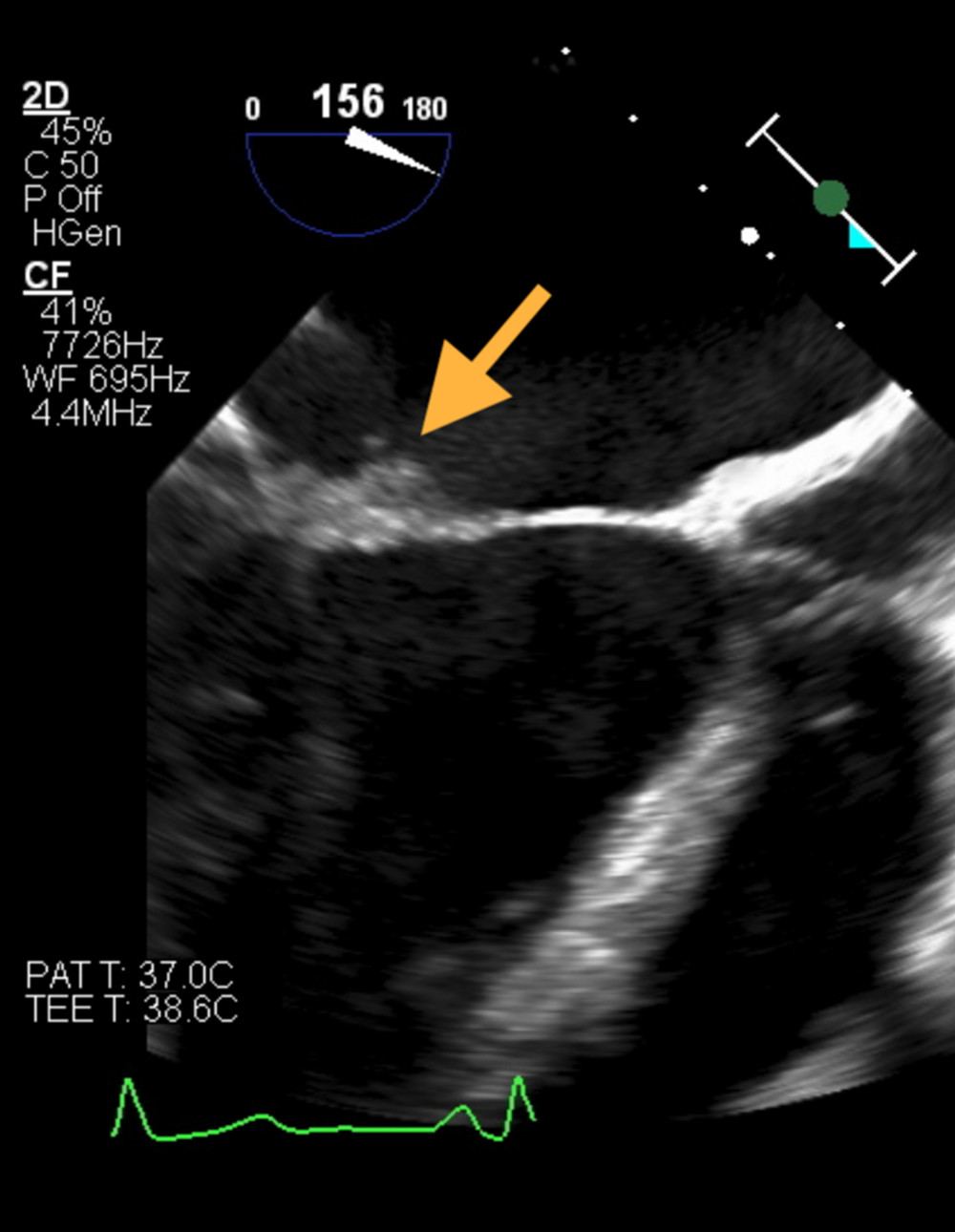 Transesophageal echocardiography. There is a 4.6×3.1 mm verruca on the mitral valve that is lumped with the valve (arrow).