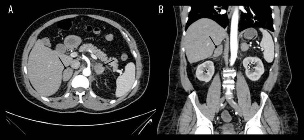 Bilateral adrenal hemorrhage on computed tomography (CT) scan. CT scan on admission showing bilateral significant adrenal glands enlargement, mildly heterogeneous, as denoted by the arrows, with noticeable fat stranding seen extending around the kidneys, diagnostic for adrenal hemorrhage. (A) Transverse view; (B) coronal view.