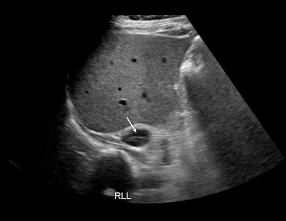 Seven-week follow-up ultrasound. Ultrasound showing the reduced size of the right adrenal enlargement, as denoted by the arrow, 3×1.7 cm (previously 4.1×2 cm).