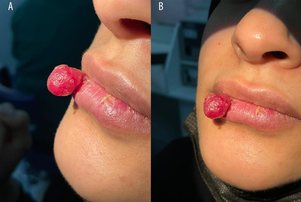 Lip lesion before excision. (A, B) A non-painful soft superficial fragile lesion measuring 1.5 × 1 cm on the right lower lip.