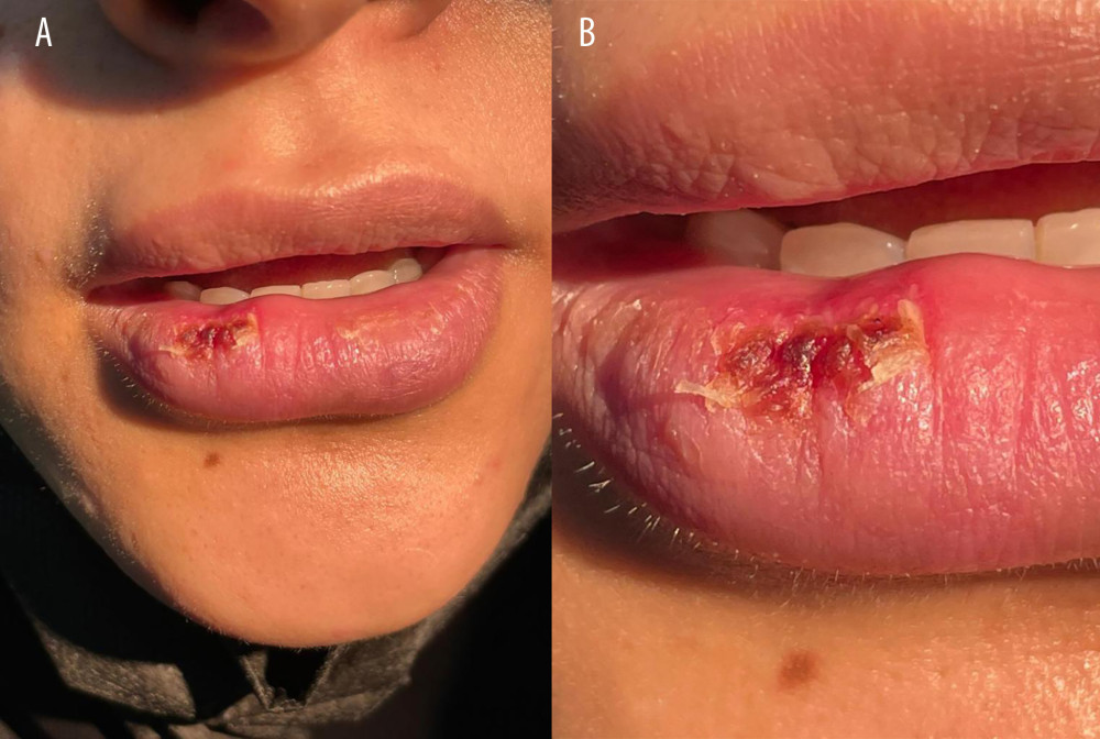 Lip lesion after excision. (A, B) Right lower lip healed lesion site after excision, with mild crusting.