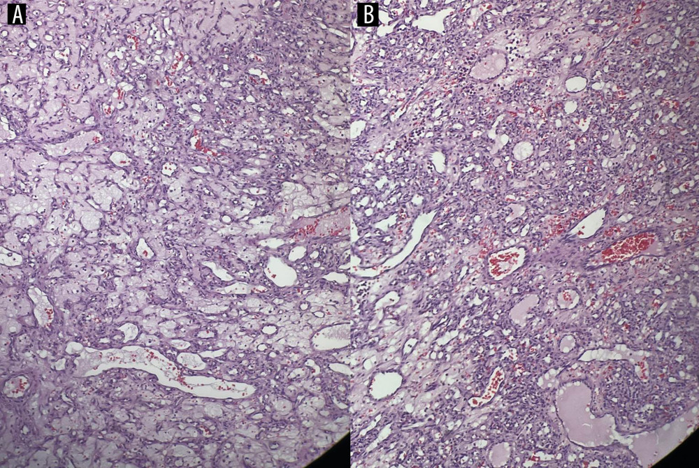 Histopathology picture. (A, B) Histopathology images of the lip lesion showing features of capillary hemangioma.