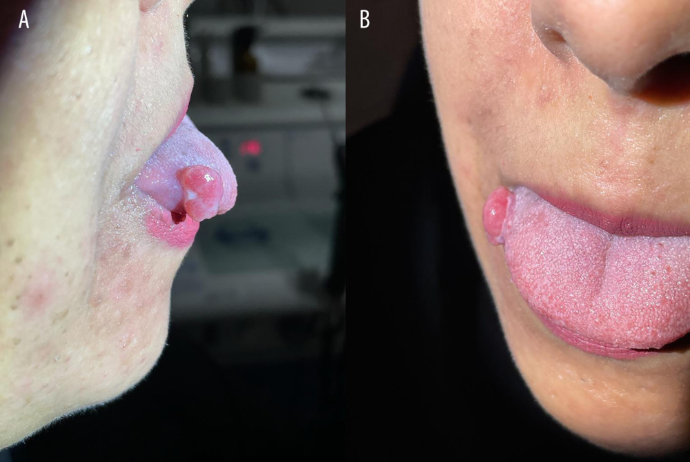 Tongue lesion. (A, B) Lesion measuring 0.7×0.5 cm over the lateral right side of the tongue at the time of presentation (before excision).