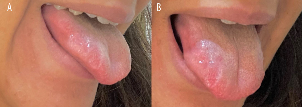 Tongue lesion after excision. (A, B) Lateral right tongue lesion site after excision is completely healed.