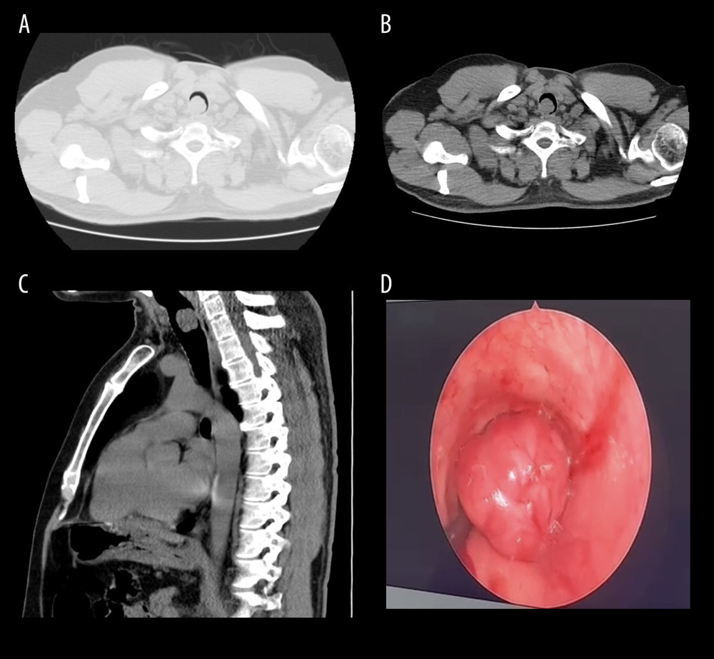 Computed tomography (CT) scan of the chest and bronchoscopic view of the tracheal mass. (A) CT scan chest axial section lung window. (B) CT scan chest axial section mediastinal window. (C) CT scan chest sagittal section mediastinal window. (D) Bronchoscopic view of the tracheal mass.