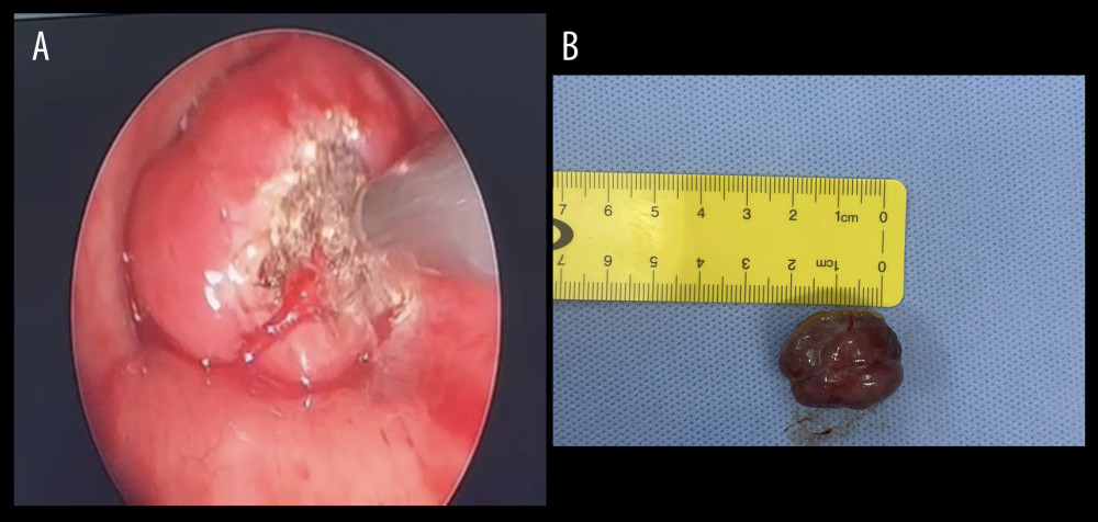 Bronchoscopic view of the tracheal mass while operating and tracheal mass after excision. (A) Suction diathermy is used at the tumor pedicle before dissection. (B) Mass after excision which was 2 cm in maximum diameter.