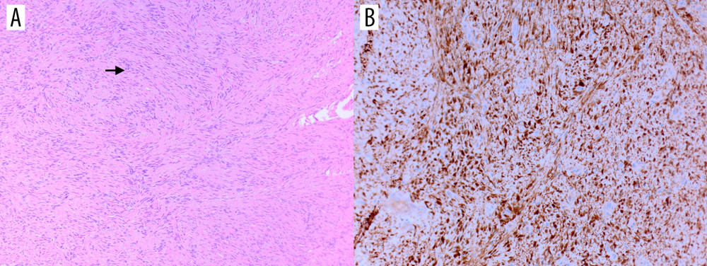 Hematoxylin and eosin staining and immunohistochemistry of tumor. (A) Hematoxylin and eosin staining showed Antoni A (arrow) growth pattern (magnification, 10×). (B) The tumor reveled positivity for S-100 protein on immunohistochemical staining (magnification, 10×).