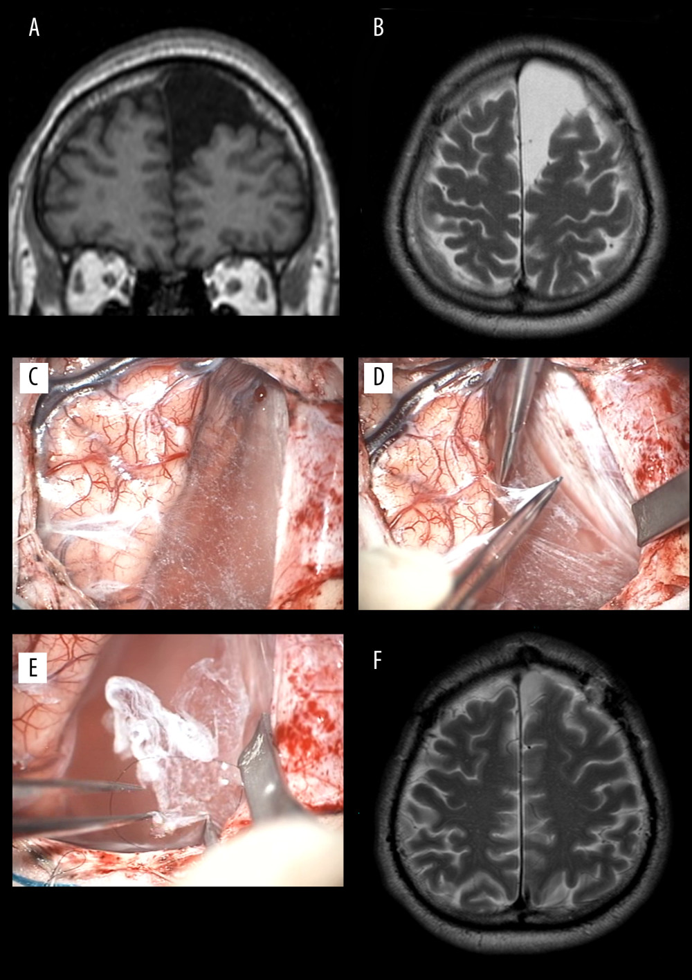 Magnetic resonance images and operative photos of Case 1. Interhemispheric mass with low-intensity (A) in T1-weighted image and a high-intensity mass (B) in T2-weighted image disappeared after the operation (F). The cavity wall, which was macroscopically identical to the arachnoid membrane (C), was resected as wide as possible (D, E) in the operative field.