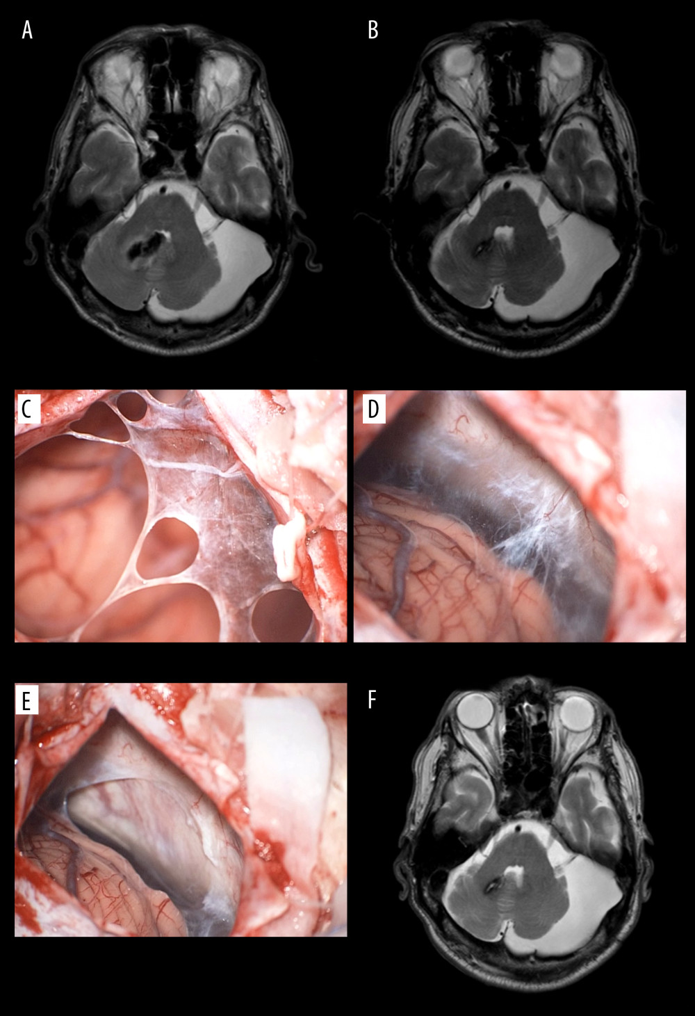Magnetic resonance images and operative photos of Case 2. Cerebellar hemorrhage, (A) as a low-intensity mass in T2-weighted image (T2WI), became smaller in size (B). The associated high-intensity mass on the left cerebellopontine angle in T2WI showed little change in size 13 months later, which lead to the surgical procedure. The retrocerebellar cavity wall was thin and fairly vascularized (C), while the wall on the side of the cerebellar tentorium was partially thickened (D). The cavity was located in the intra-arachnoid layer (E). The cavity wall of the left cerebellopontine angle was resected, but the cavity size showed no change (F).
