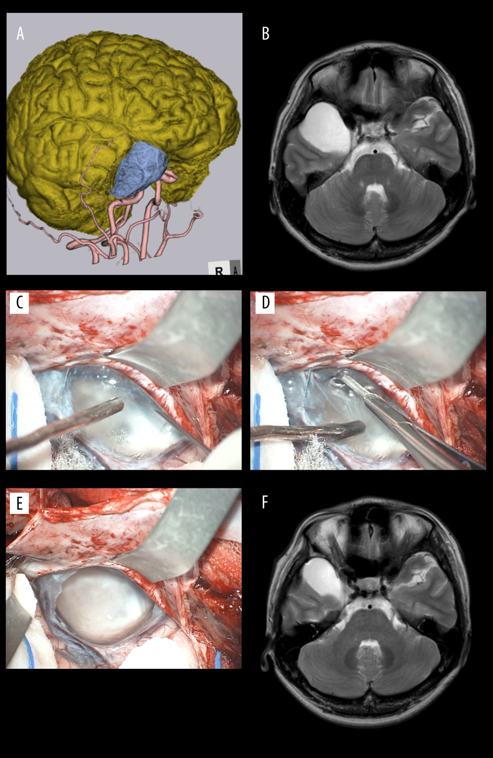 Magnetic resonance images and operative photos of Case 3. Surface anatomy scan (A) and T2-weighted image (B) show a mass in the right temporal pole, which reduced in size (F) after the operation. The cavity wall looked identical to the arachnoid membrane (C) and is resected (D) as wide as possible (E).