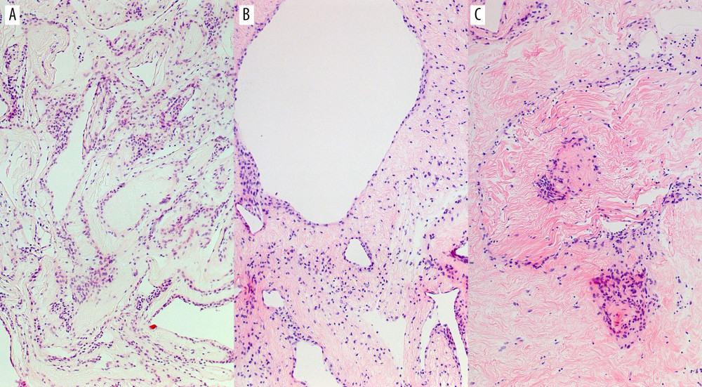 Photomicrograph of hematoxylin-eosin staining of the specimens. Cells with small nuclei showing no atypicality are arranged like an epithelium forming several thicker lamellae (A). Vessels are rarely observed. In the thick part of the cavity wall, a round space is seen (B), resembling epithelialized vacuoles. Connective tissue is seen in between (C) but not as rich. Original magnification is ×10.