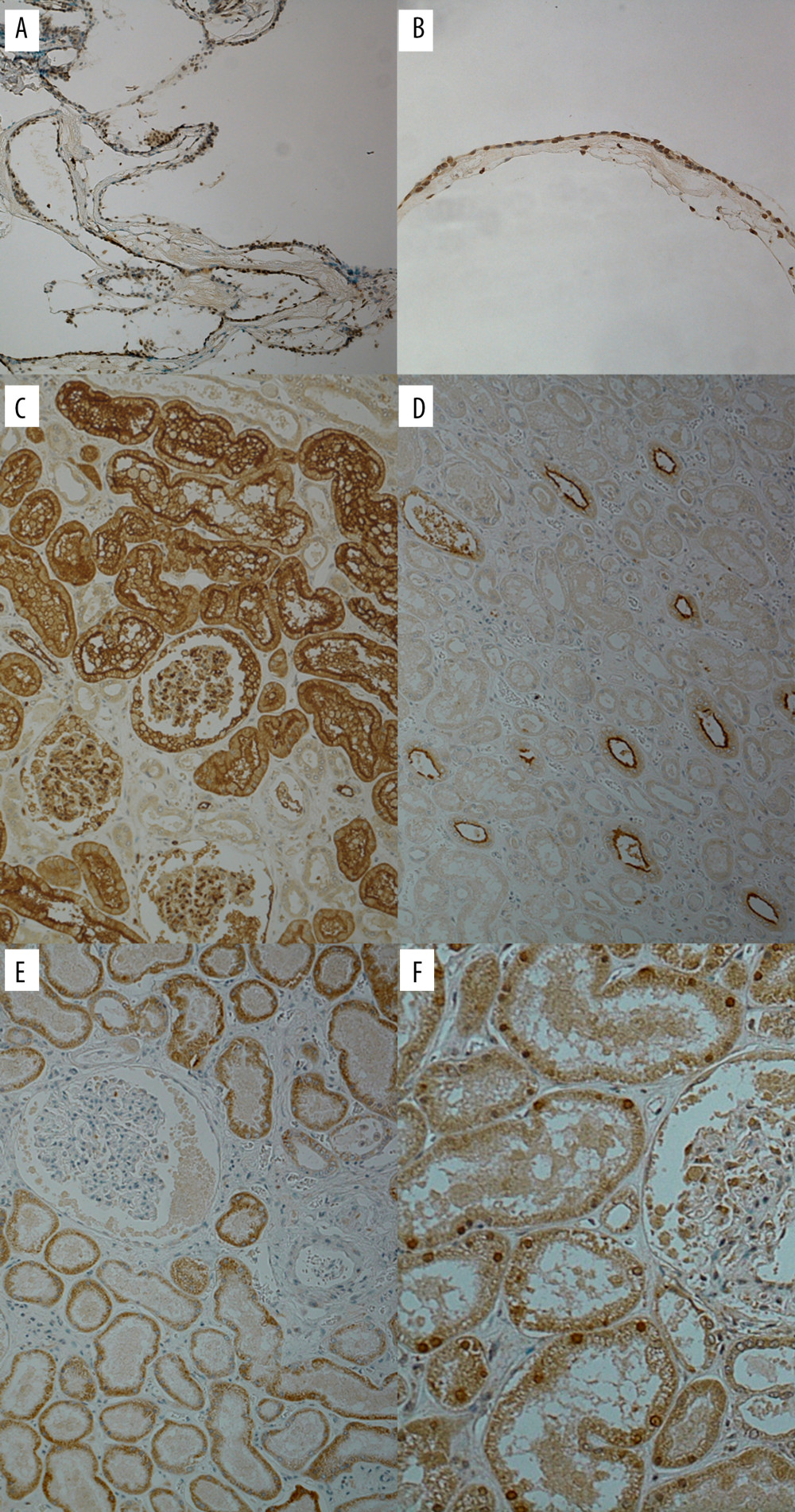 Aquaporin staining. The specimen from Case 1 stains positive for aquaporin (AQP) 1 (A) and AQP 5 (B). As a control, kidney tissue is stained for AQP 1 (C), 2 (D), 3 (E), and 5 (F). Original magnification is ×20 for B and F, while the rest are ×10.