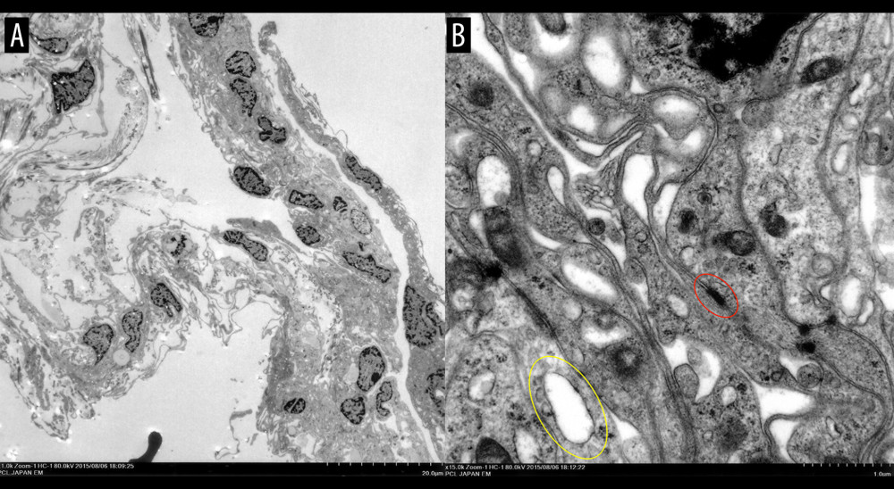 Electron microscopic photos. Cells with many or few cell organelles, and spindle-like nuclei are arranged in lamellar or flattened structures (A). Many vacuolizations (oval colored in yellow) are seen intracellularly. Multiple desmosomes (oval colored in red) are also observed (B).
