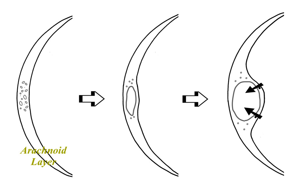 Possible mechanism of arachnoid cyst development. In a certain part of the arachnoid layer rich with microvacuoles (left), they fuse (middle) and become a larger cavity (right) in which water is transported by aquaporin (black arrows).