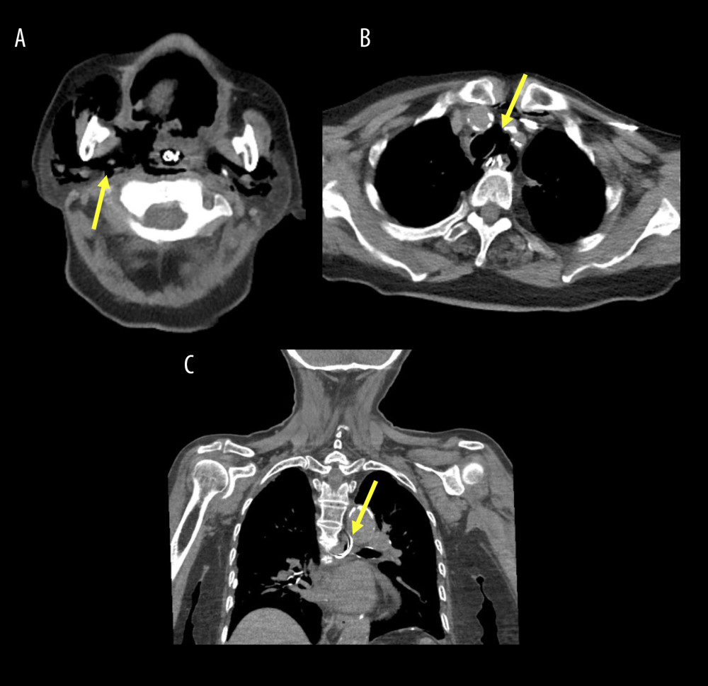 (A) Computed tomography (CT) scan shows cervical emphysema and the distal end of the NGT in the nasopharynx (arrow). (B) CT scan shows pneumomediastinum (arrow). (C) CT scan shows the bent NGT at the esophagus (arrow).