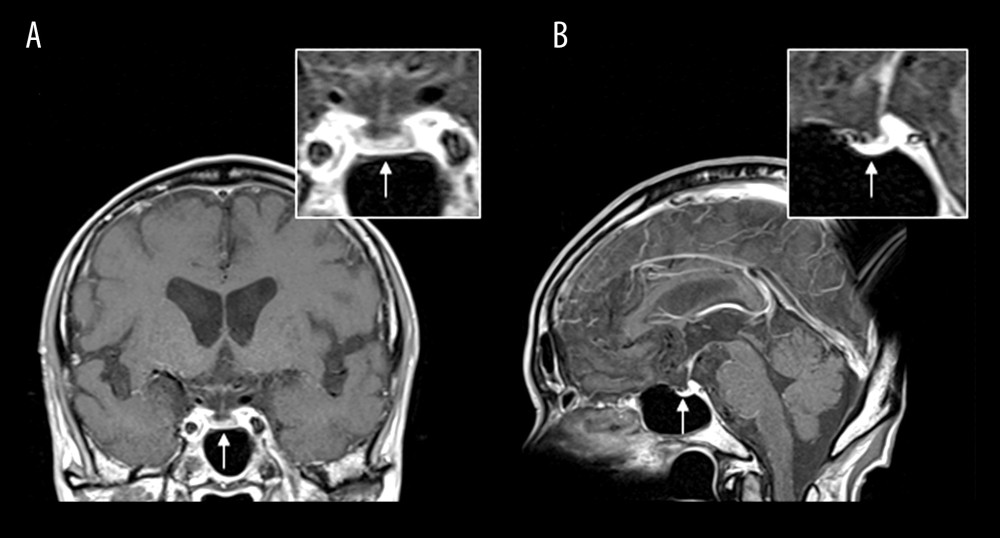 Magnetic resonance imaging of the brain. Gadolinium-enhanced T1-weighted images (A, coronal plane; B, sagittal plane) showing no abnormality in the hypothalamus, hypophyseal stalk, or pituitary gland (arrows).