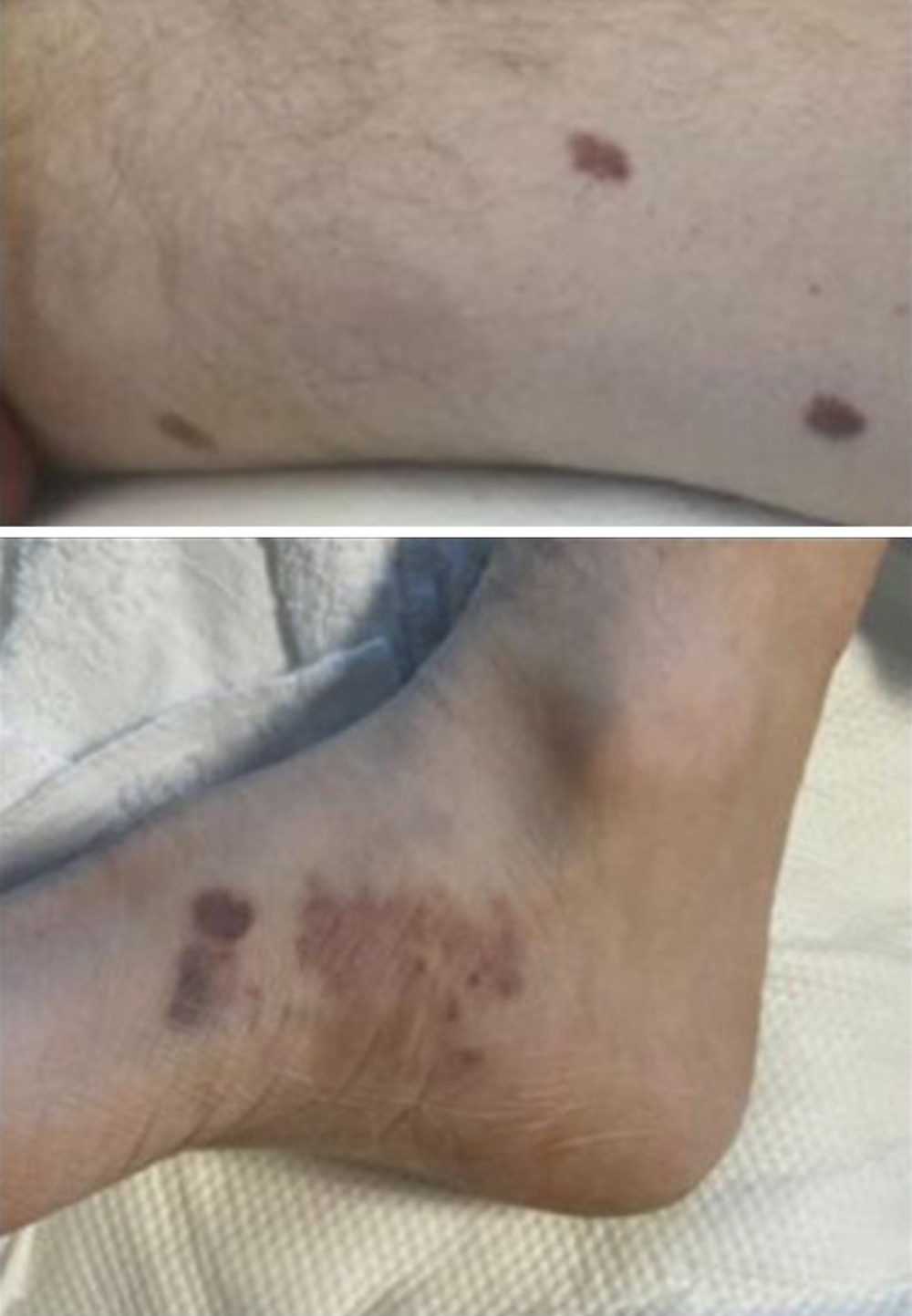 Photograph of Kaposi sarcoma skin lesions.