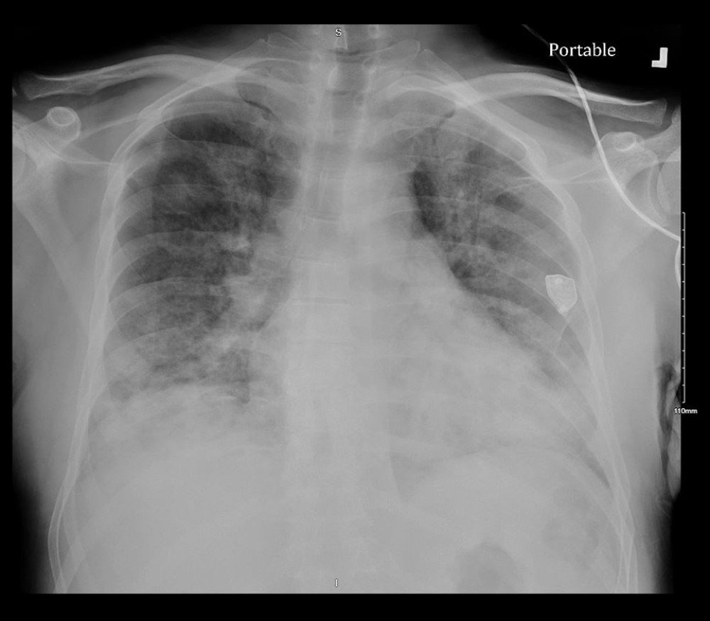 Chest radiograph, hospital day 1. Bilateral prominence of the interstitium and alveolar opacities. No effusions are seen.