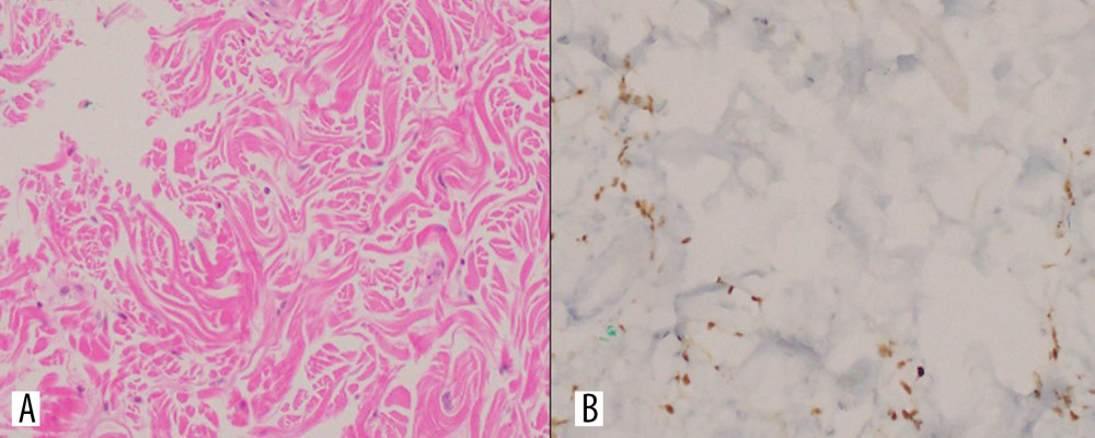 Dermatopathology of skin biopsy. (A) Sections show skin with irregularly-shaped, branching, and slit-like channels containing erythrocytes and are lined by spindle cells. A sparse lymphohistiocytic infiltrate with occasional plasma cells is also present. (B) HHV-8 stains the endothelial cells in a nuclear pattern. Diagnosis: Kaposi sarcoma, patch/plaque stage.