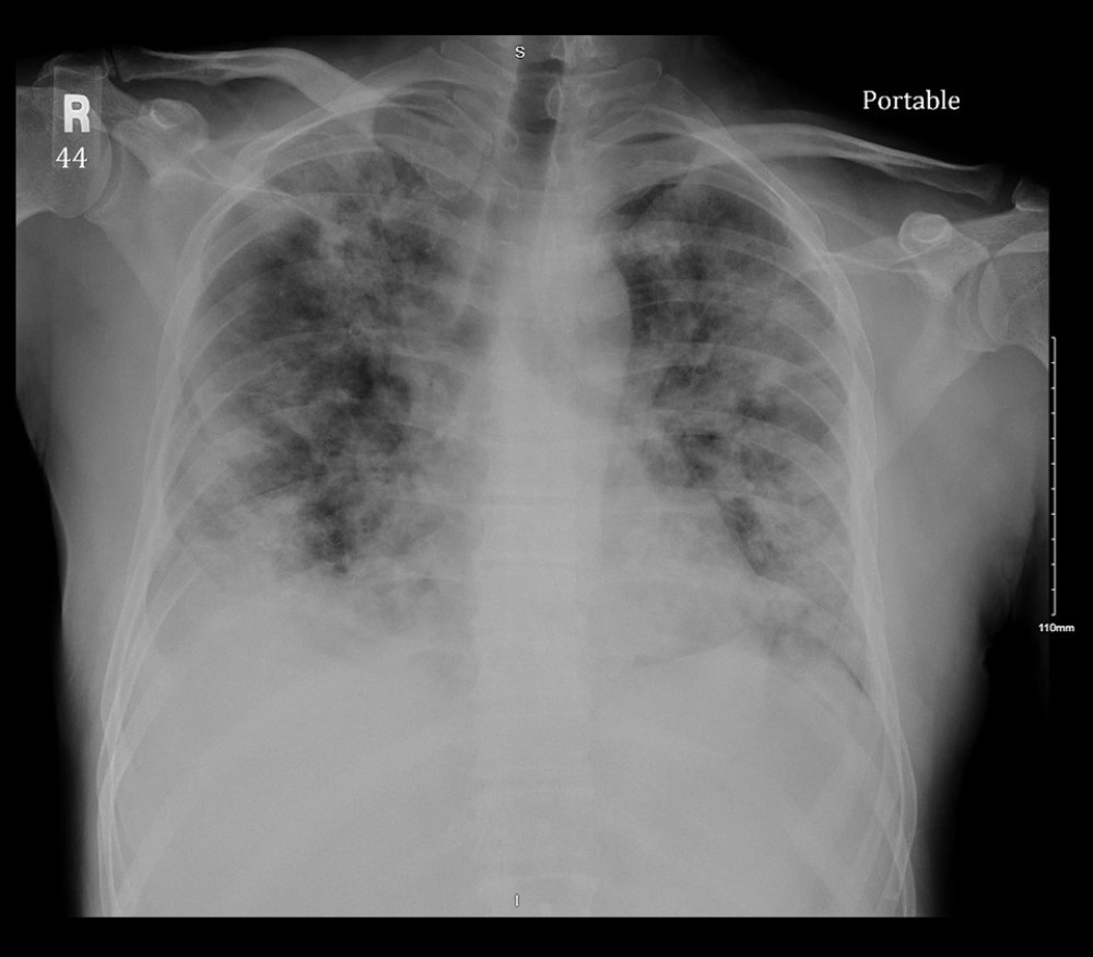Chest radiograph, hospital day 4. Severe diffuse bilateral airspace consolidations worsened from prior radiograph. Bilateral pleural effusions, right greater than left.