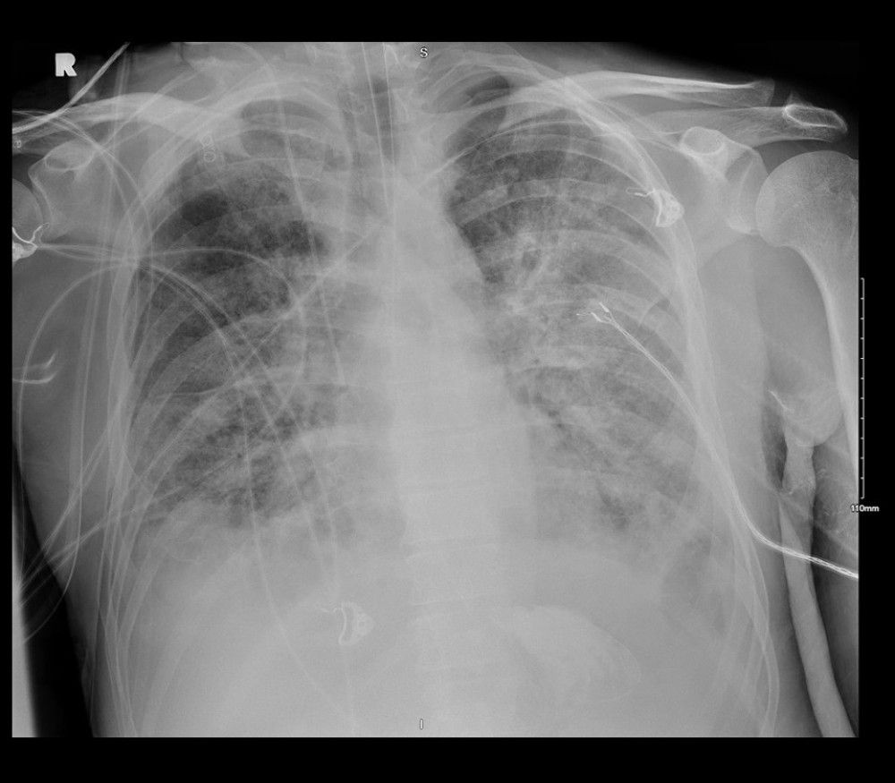 Chest radiograph, hospital day 28. Extensive bilateral diffuse airspace disease with bilateral pleural effusions, which appear worsened compared to previous examination.