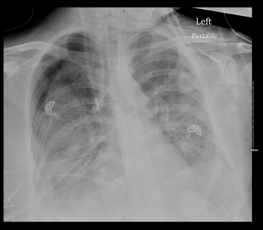 Chest radiograph, hospital day 32. Moderate right pneumothorax, which was not seen on the most recent radiograph. Bilateral airspace disease present. Nasogastric tube, right internal jugular catheter, left internal jugular catheter also present.