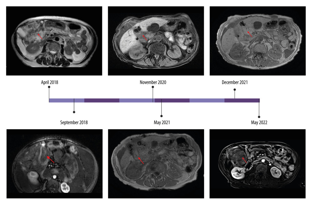 Progression of tumor lesion. MRI sequence presenting the mass with low signal. Red arrows show the tumor lesion.