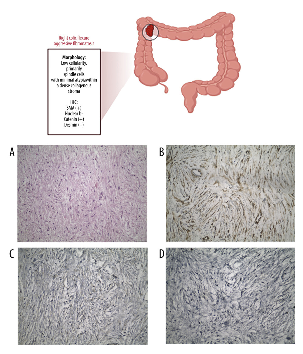 The tumor exhibited low cellularity, comprising mainly spindle cells with minimal atypia in a thick collagenous background (H & E staining) (A). On immunohistochemistry, tumor cells were positive for SMA (B) and beta-catenin (C). On immunohistochemistry, tumor cells were negative for desmin (D). Magnification 20×.